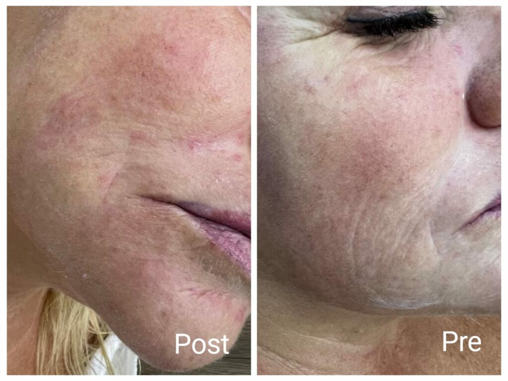 نتيجة حقنة واحدة جاليبرو ازالة تجاعيد الوجه وخطوط حول الفم